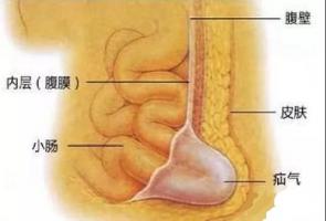 腹透有关并发症及处置的宝典